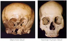 The Mystery behind the Starchild skull: The remains of an ancient Alien?