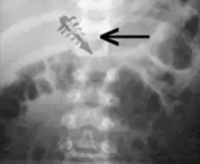 Alien Implants: The Ultimate Proof Of Alien Abductions?