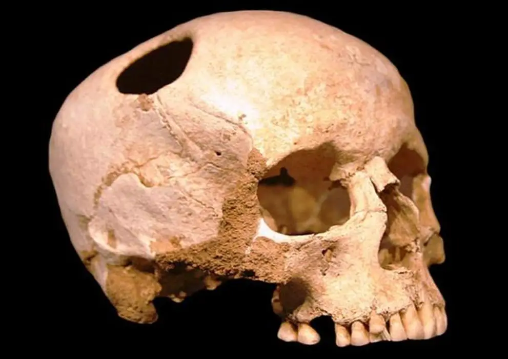 Girl skull, trepanated with flint tools; neolithic (3500 BC) ; patient survived. Natural History Museum, Lausanne ( CC BY SA 2.0 )