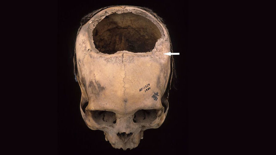 Peruvian skull from approx. 400-200 B.C.E. 