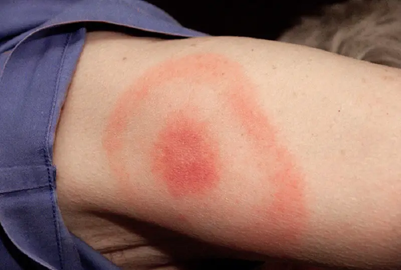 Lyme disease causes this rash