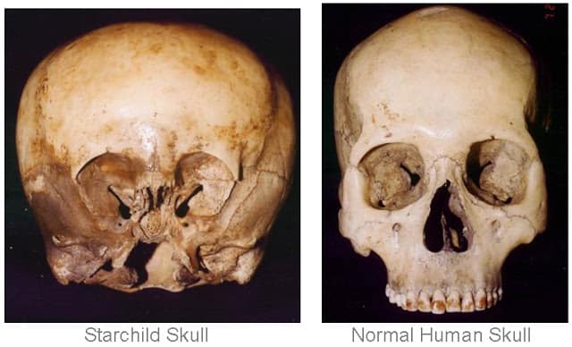 The Mystery behind the Starchild skull: The remains of an ancient Alien?